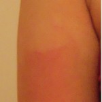 Sunburned Arm Sunburned Arm